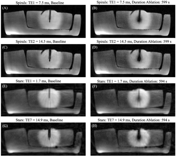 Evaluation study of radial and spiral based volumetric thermometry for monitoring of hepatic microwave ablation