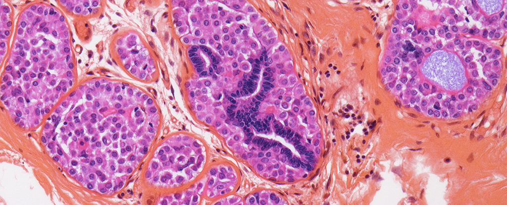 Breast Cancer Often Returns – But We May Have a New Way to Stop It : ScienceAlert