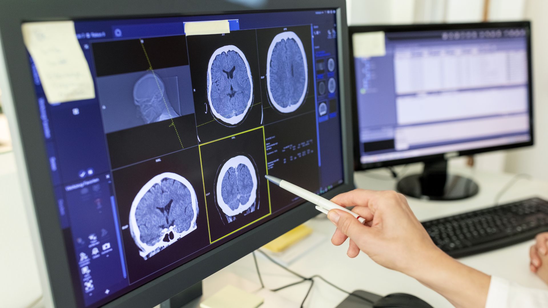 Overactive brain region linked to autism and seizures in mice