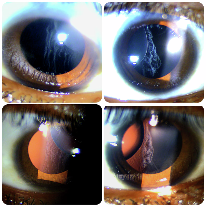 Visible zonular breaks in Marfan related ectopia lentis