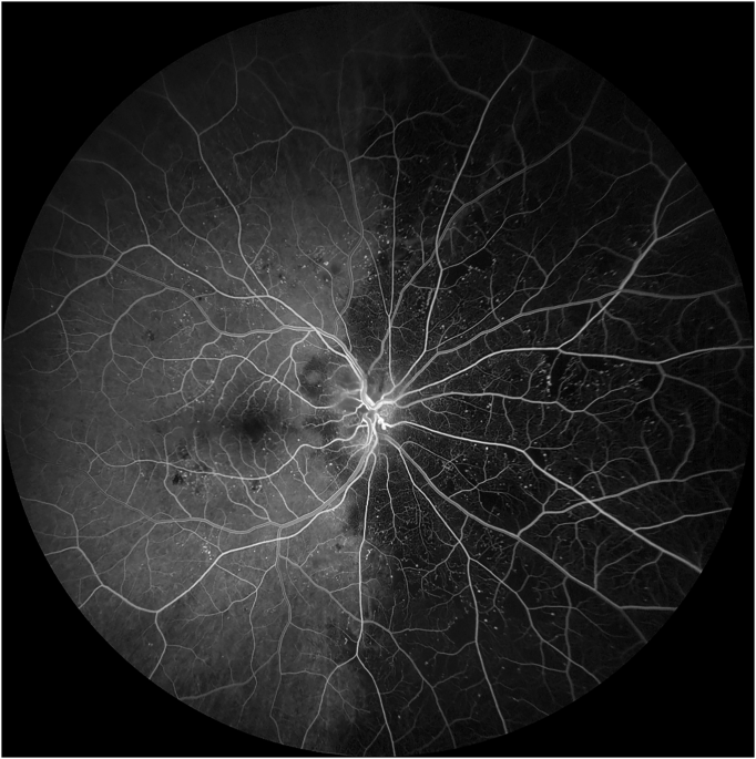 Posterior ciliary artery occlusion