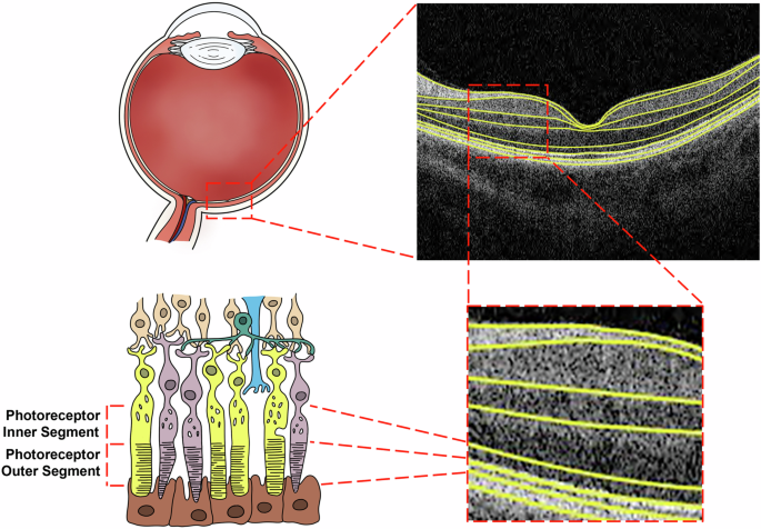 Photoreceptor layer thinning is an early biomarker for type 2 diabetes: a cohort study in UK Biobank
