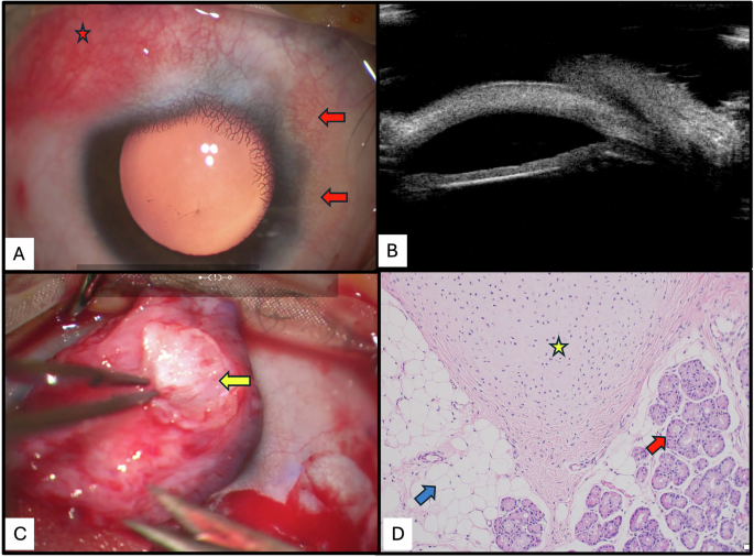 A rare case of epibulbar teratoma in an infant