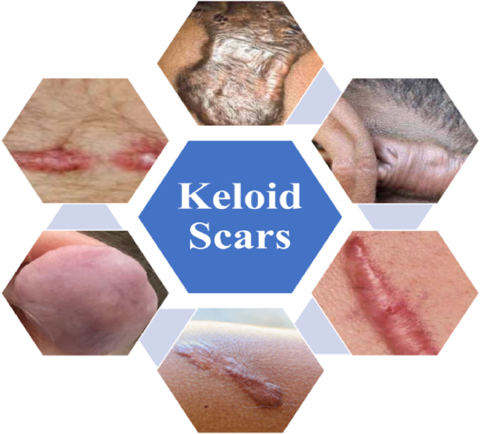 Prediction of suitable drug for keloid through analytic hierarchy process and topological indices