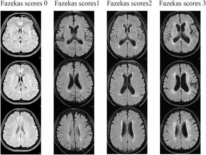 Clinical application of 3D reconstruction and accurate volume measurement of white matter in patients with cognitive dysfunction