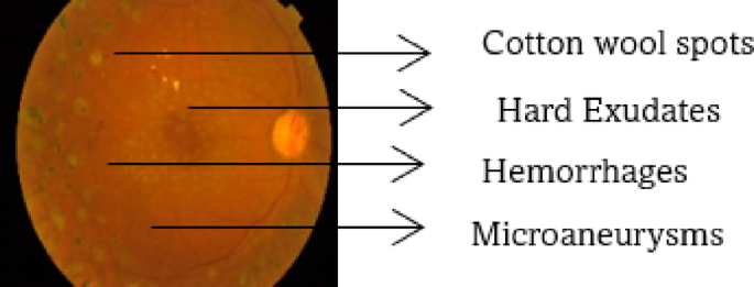 DRCNN-Lesion Proxy: a hybrid CNN with lesion-inspired feature simulation for diabetic retinopathy severity classification