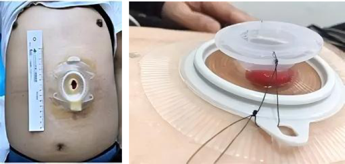 Intelligent monitoring system for quality of life of colostomy patients based on deep learning and AR