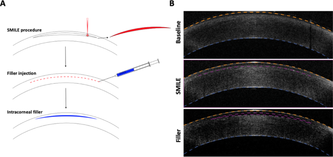 Ex vivo evaluation of corneal filler injection for enhancement after small incision lenticule extraction