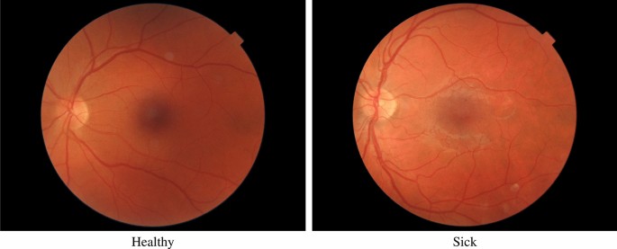 Diagnostics of diabetic retinopathy based on fundus photos using machine learning methods with advanced feature engineering algorithms