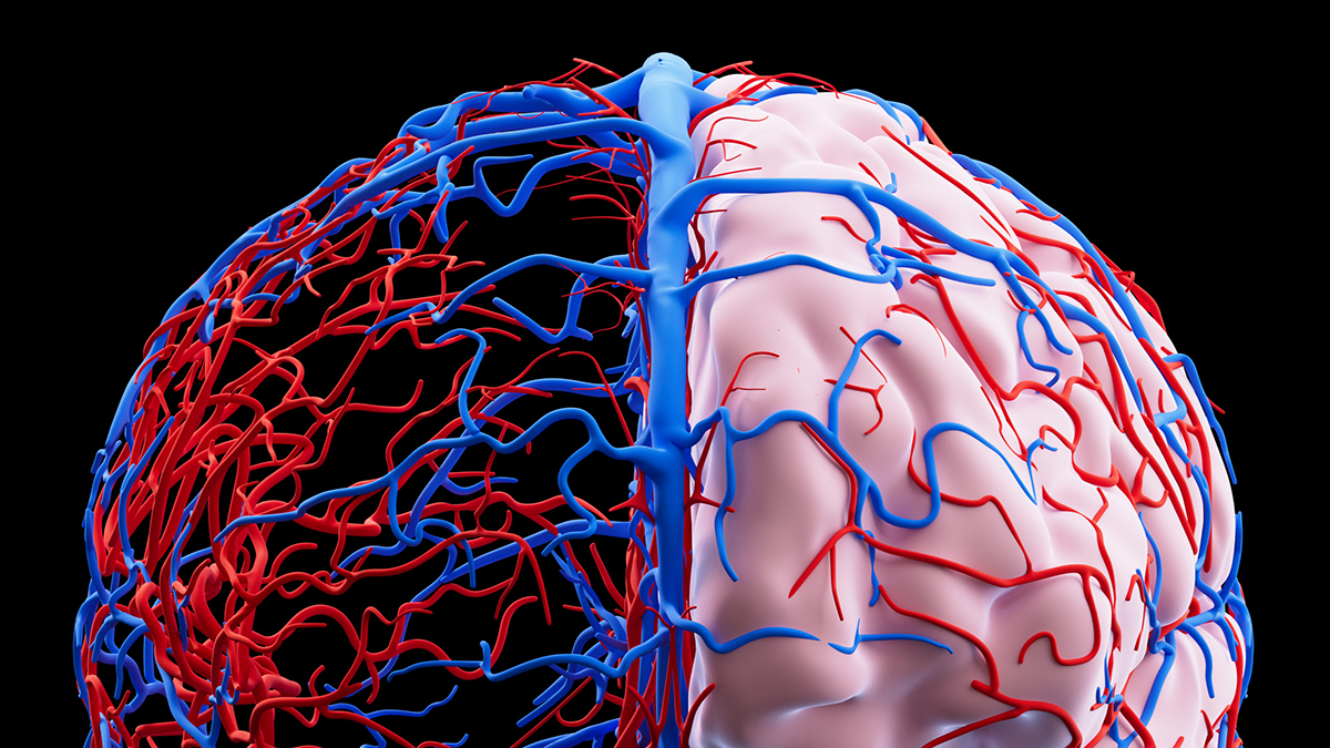 Microplastics May Be Tied to Vascular Dementia Cases, Review Finds : ScienceAlert