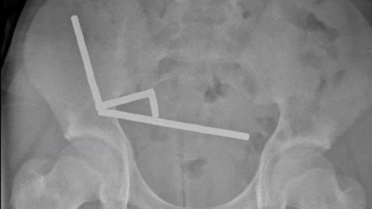 New Zealand Teen Loses Part of His Bowel After Swallowing Nearly 200 Magnets : ScienceAlert