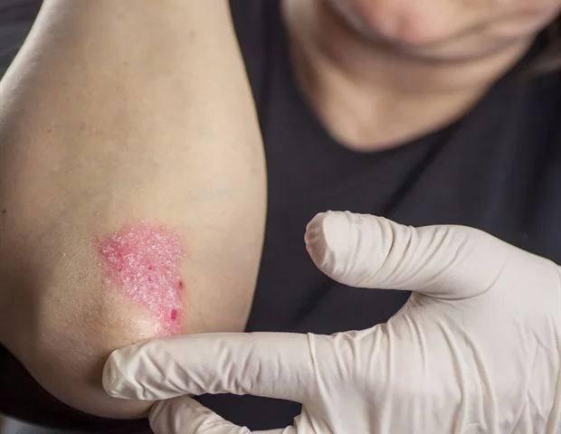Psoriasis-linked gene mutation may also play a surprising role in gut health