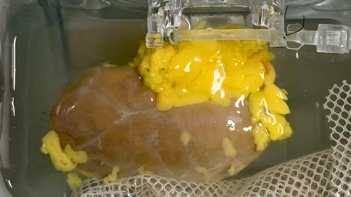 Scientists Create ‘Universal’ Kidney To Match Any Blood Type : ScienceAlert