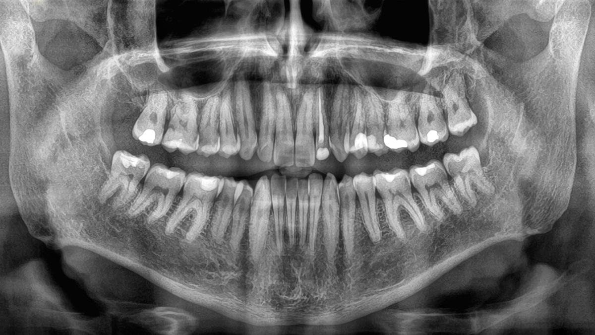 Losing Your Teeth Could Be a Deadly Warning, Study Finds : ScienceAlert