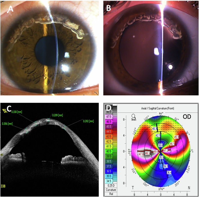Young-onset unilateral Terrien’s marginal degeneration: a rarity within rare