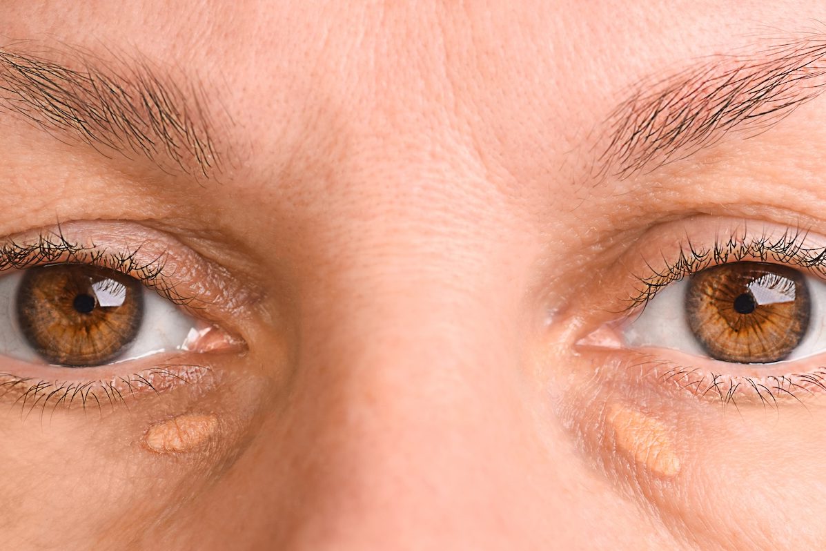 Most people with high-cholesterol gene don’t know they have it, warns study