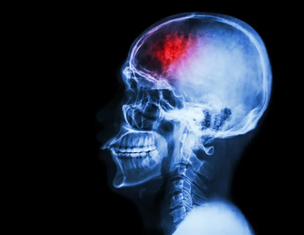 Disrupted brainstem-parahippocampal connectivity identified as a biomarker for delirium