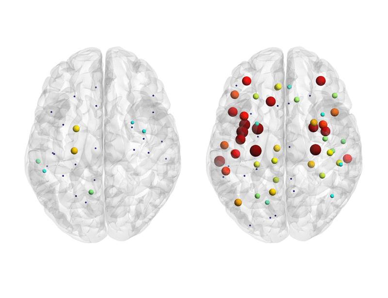Targeting brain hubs of ictal fast ripple activity to reduce seizures in patients with drug-resistant epilepsy | Science Translational Medicine