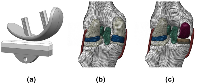 Biomechanical analysis of femoral component malalignment in medial unicompartmental knee arthroplasty
