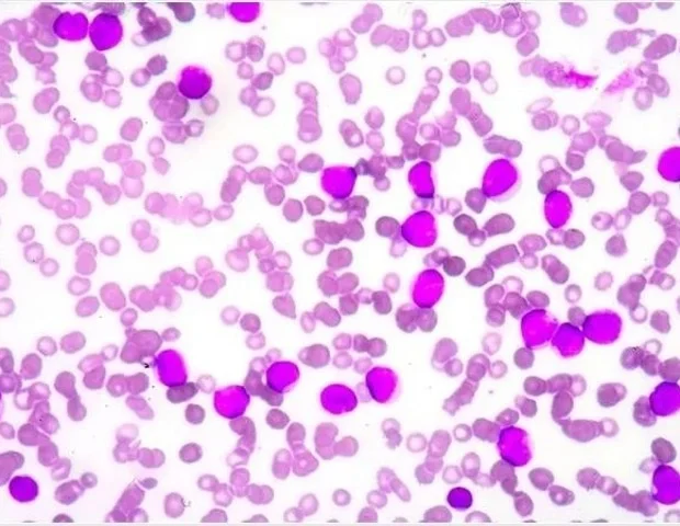 Exclusive licensing agreement accelerates PHD inhibitor development for anemia in CKD patients