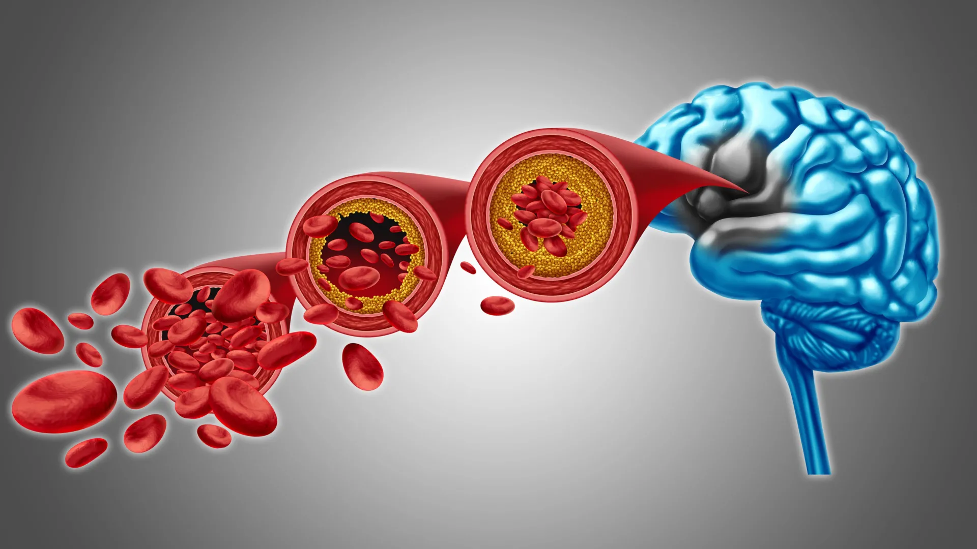 Scientists found a way to restore brain blood flow in dementia