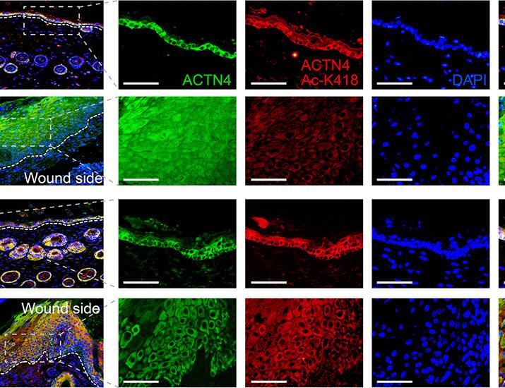 HDAC5 deacetylates cytosolic ACTN4 during skin reepithelialization and represents a therapeutic target for chronic wound healing | Science Translational Medicine