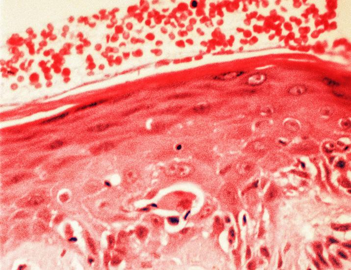 Dermatomyositis is characterized by JAK1-mediated monocyte-driven vasculopathy and inflammation | Science Translational Medicine