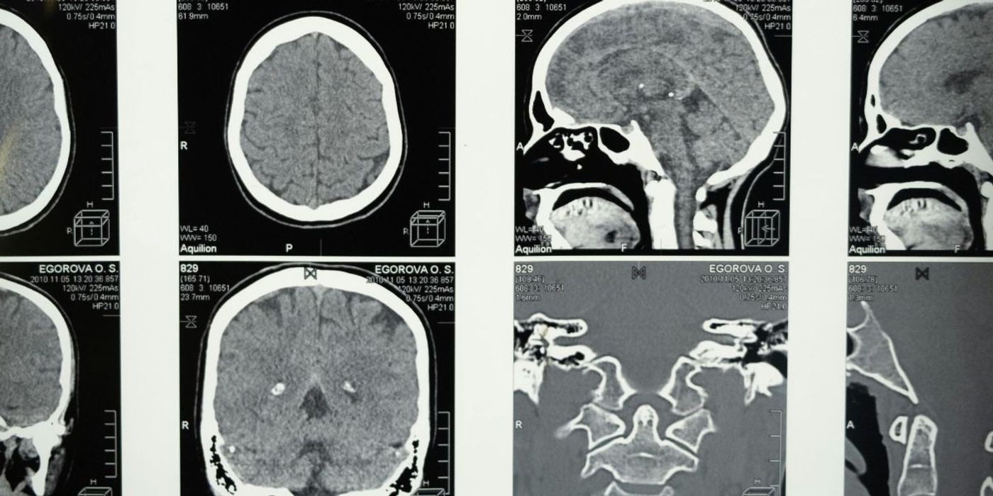 Intranasal Nanotherapy Shows Promise Against Glioblastomas