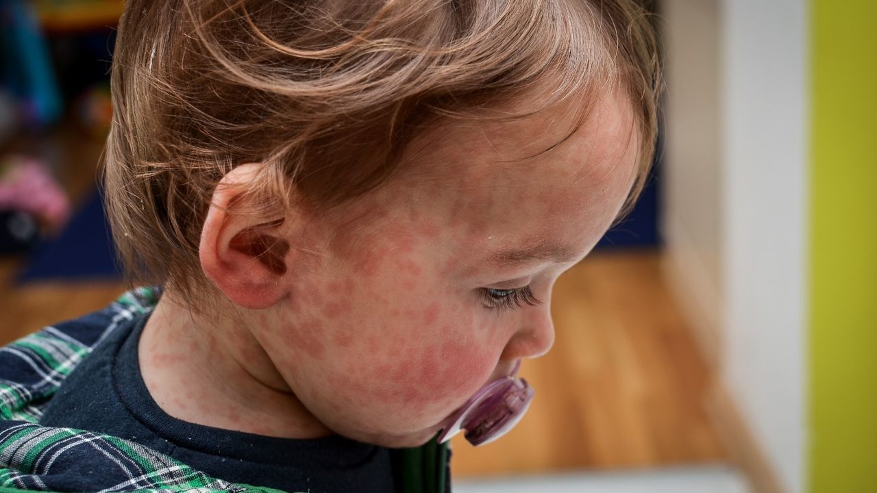 The UK has lost its measles elimination status — again