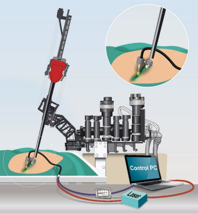 Bowel incision closure with a semi-mutomated Robot-assisted laser tissue soldering system
