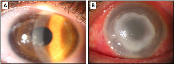 Nested PCR as a superior diagnostic method for Acanthamoeba keratitis compared to conventional techniques
