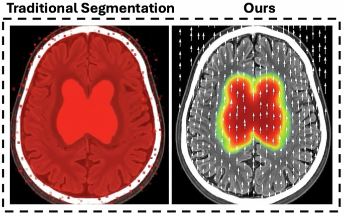 Modeling Ischemic Stroke Pathological Dynamics via Continuous Fields and Vector Flow