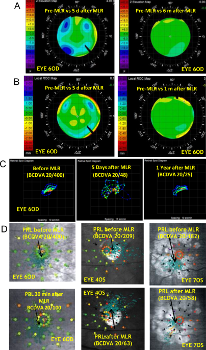 Outcomes up to two years after Excimer-Laser-Multiple-Light-Redirection (Excimer-MLR) corneal treatment for retinal disorders with central visual loss