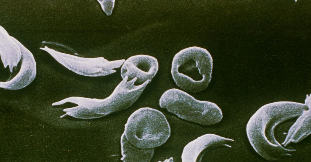 In 2023, the UK was the first country to approve a Crispr therapy. How’s it doing? | News