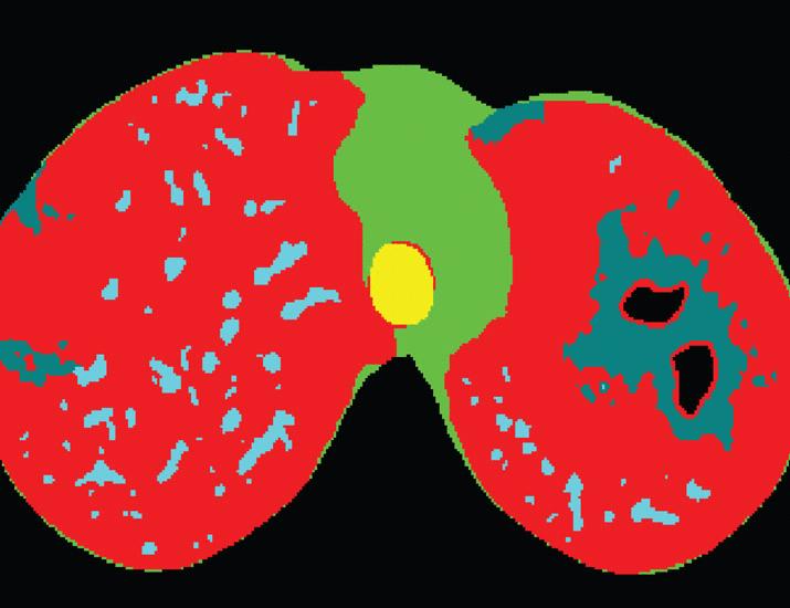 Clinical testing of drug treatment shortening in patients with TB using PET/CT imaging of lung lesions | Science Translational Medicine