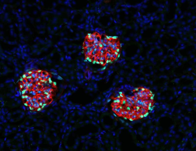 Endothelial cell–released CD93 contributes to podocyte injury in idiopathic nephrotic syndrome | Science Translational Medicine