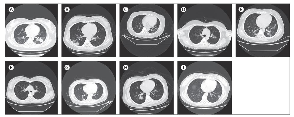 Coronavirus Is Not Passed From Mother to Child Late In Pregnancy