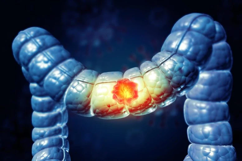 Alcohol’s Hidden Cancer Risk Builds Over Time