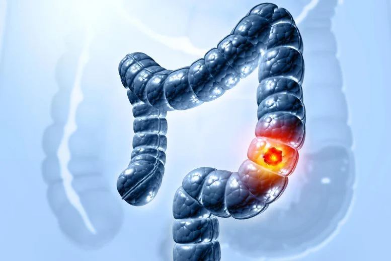 Stiffer Colon Linked to Increased Risk of Early-Onset Cancer