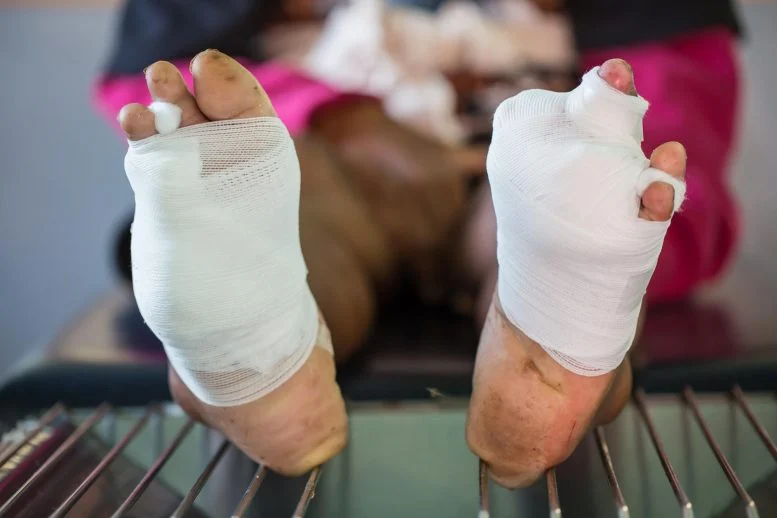 What’s Lurking in Diabetic Foot Wounds May Explain Treatment Failure