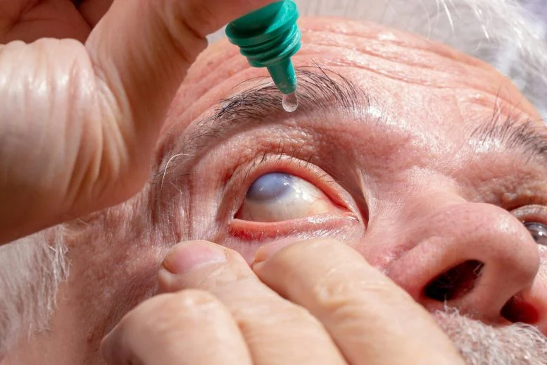 Doctors Warn a Widely Used Eye Ointment Can Damage Glaucoma Implants