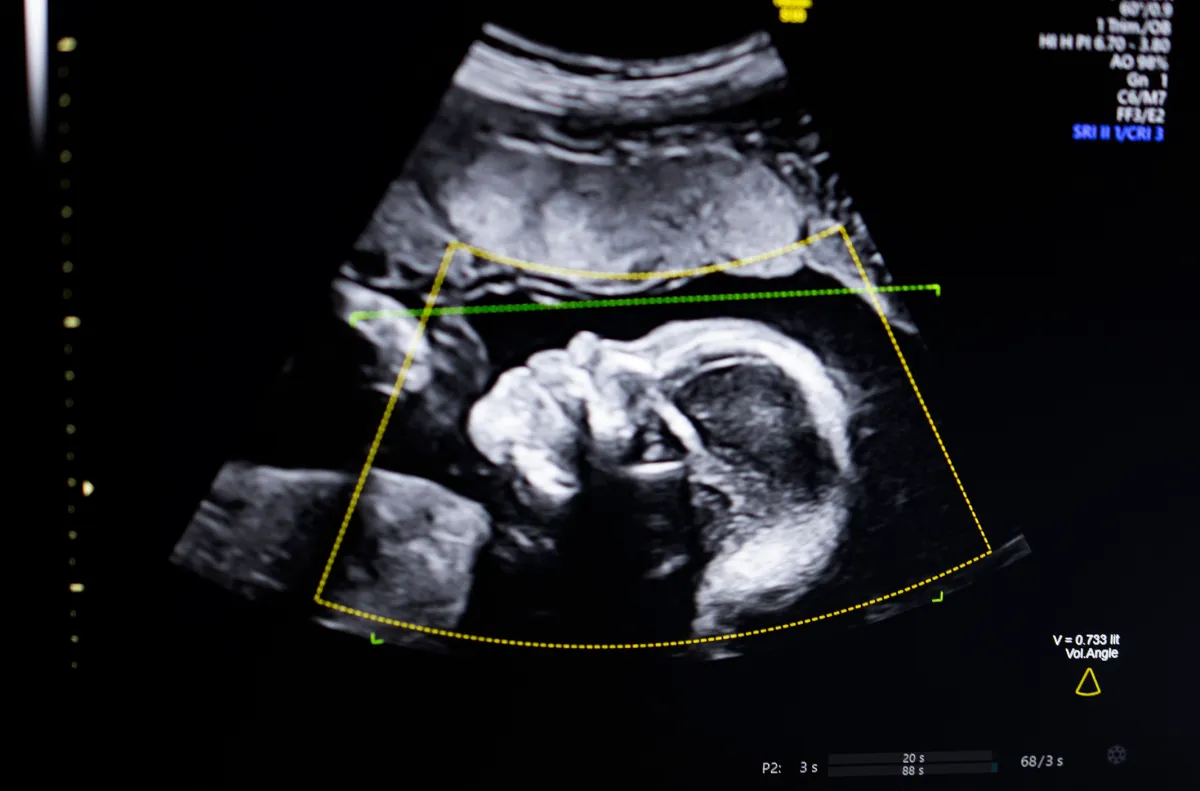 BioticsAI, which won Disrupt’s Battlefield competition in 2023, gains FDA approval for its AI-powered fetal ultrasound product