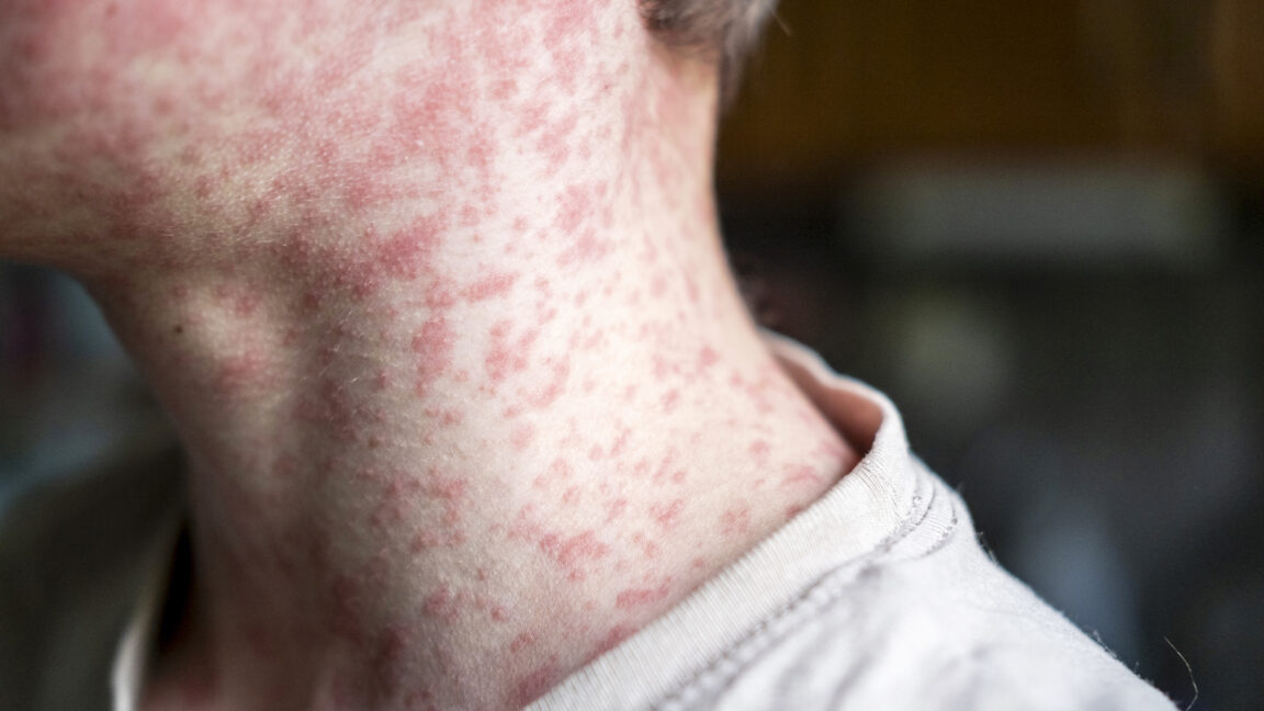 Over 250 people quarantined in South Carolina as measles outbreak rages
