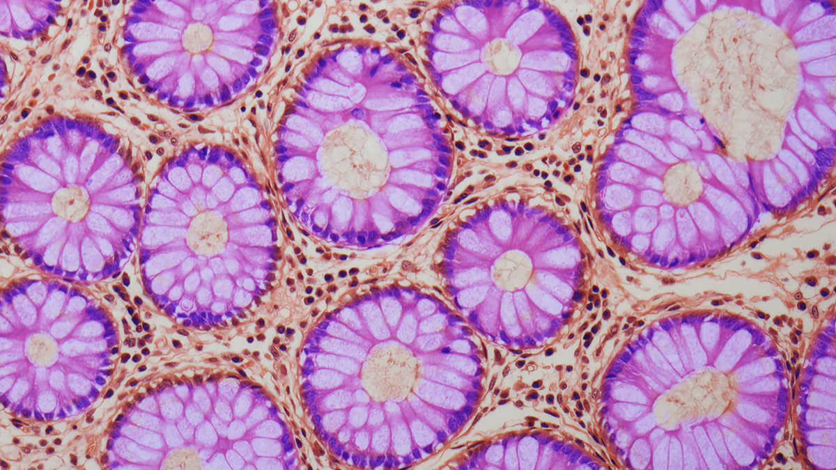 A Hidden Warning Sign Discovered in The Gut May Increase Cancer Risk : ScienceAlert