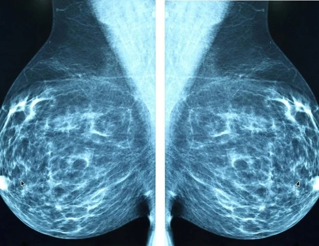 Purdue researchers discover new therapeutic target for triple-negative breast cancer