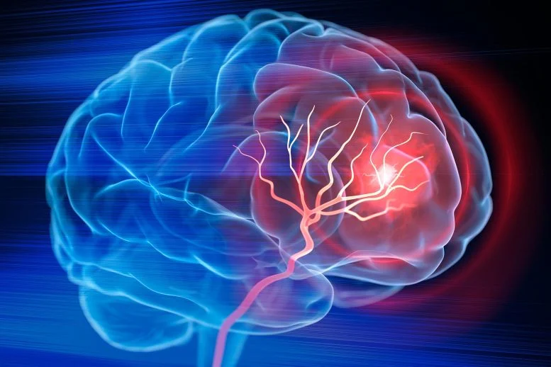 Scientists Develop IV Therapy That Repairs the Brain After Stroke