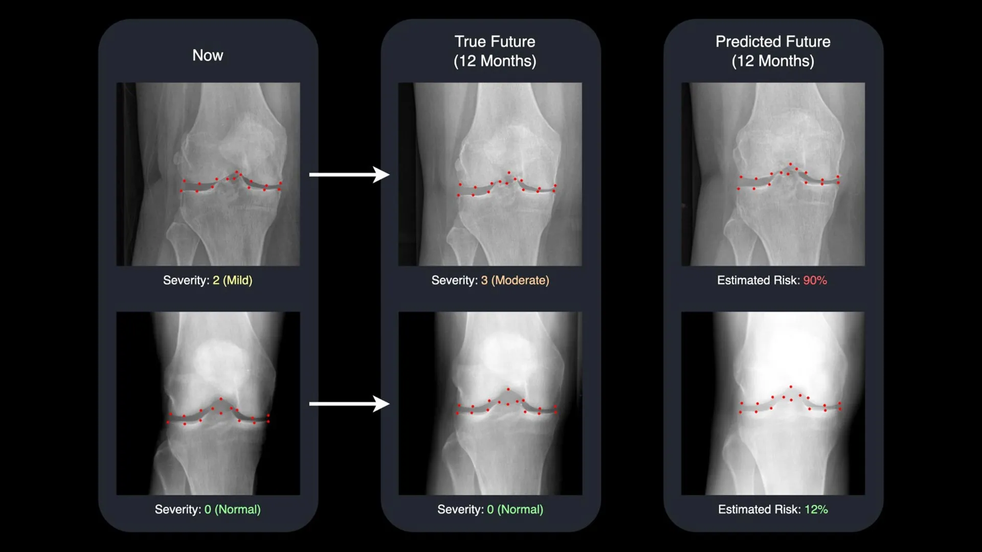 AI turns x-rays into time machines for arthritis care