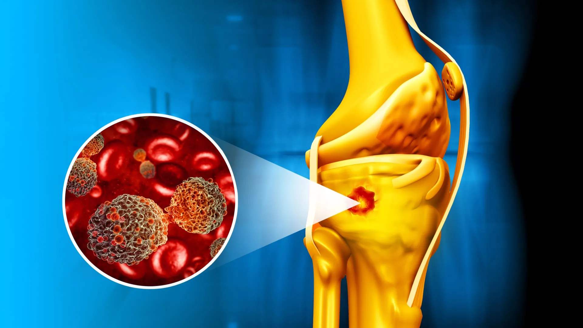 Magnetic nanoparticles fight bone cancer and help healing