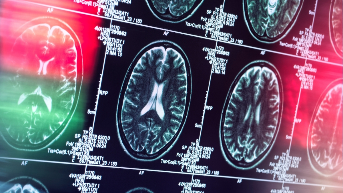 Alzheimer’s Might Not Actually Be a Brain Disease, Reveals Expert : ScienceAlert