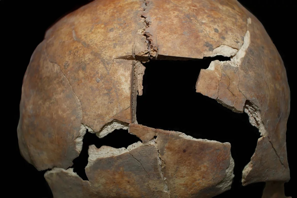 Evidence of Bronze Age cranial surgery found at ancient Megiddo
